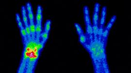 Hands x-rayed