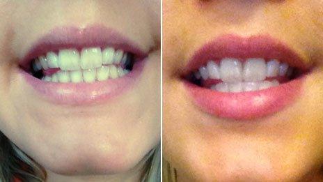 Sophie Lewis teeth
