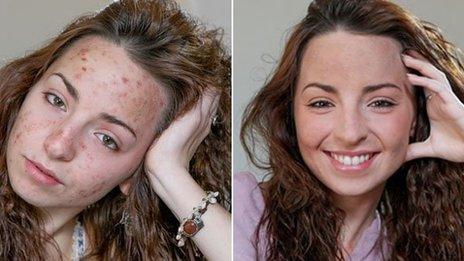 Psoriasis Sufferer Jessica Gough Let Down By Her Gp Bbc Newsbeat