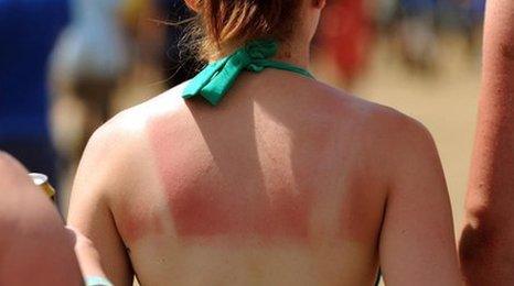 Woman with sunburn