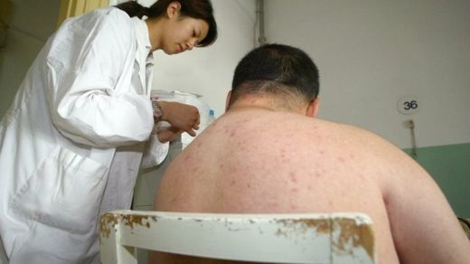 SHANGHAI, CHINA: A doctor treats an obese patient at a hospital in Shanghai, 25 May 2004.