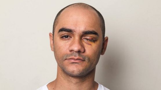 Sérgio Silva em 2013, após perder o olho esquerdo, atingido por tiro de bala de borracha disparado por policial em manifestação