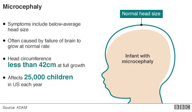 Microcephaly graphic