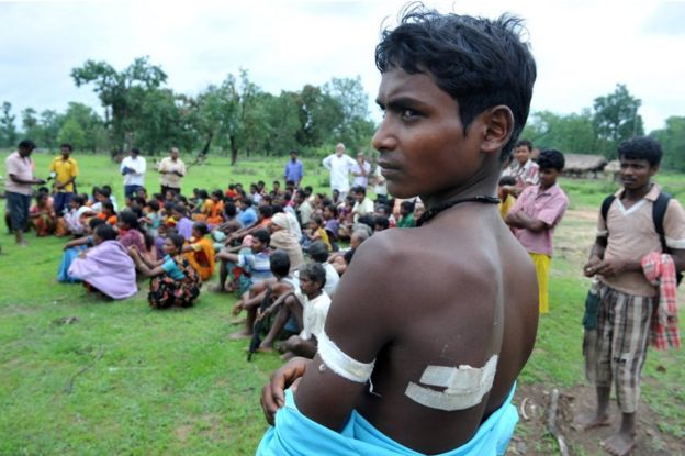 Indian villager Kaka Ramesh reveals his injuries in the village of Kothaguda in Bijapur District on July 7, 2012, after being injured in an encounter between Maoist rebels and security forces in the central Indian state of Chhattisgarh.