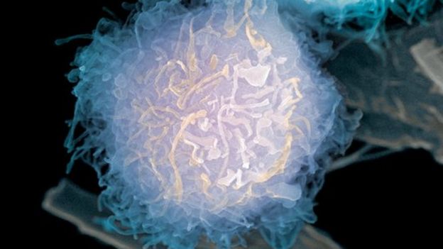 prostate cancer