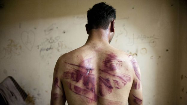 Exprisionero de una cárcel en Alepo en Siria con marcas rojas de quemaduras y heridas en la espalda
