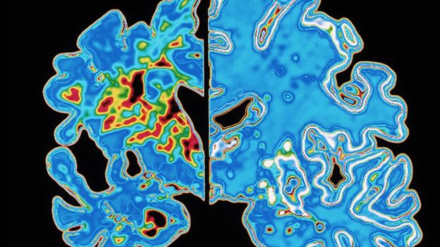 Scan of brain showing Alzheimer's vs normal