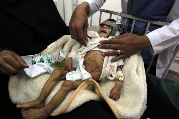 A picture made available on 19 January 2017 shows a Yemeni child, suffering from malnutrition, being treated at a hospital in Sanaa, Yemen