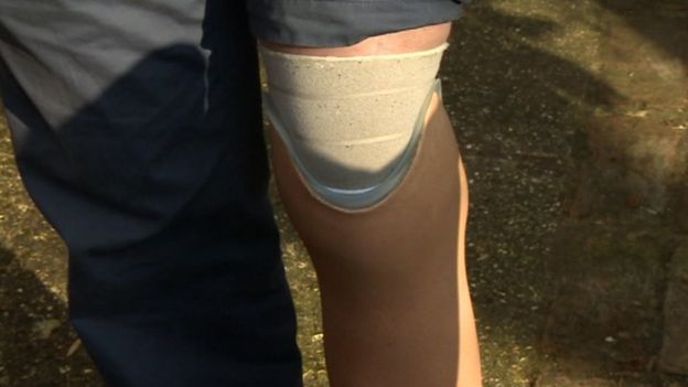 Prosthetic leg