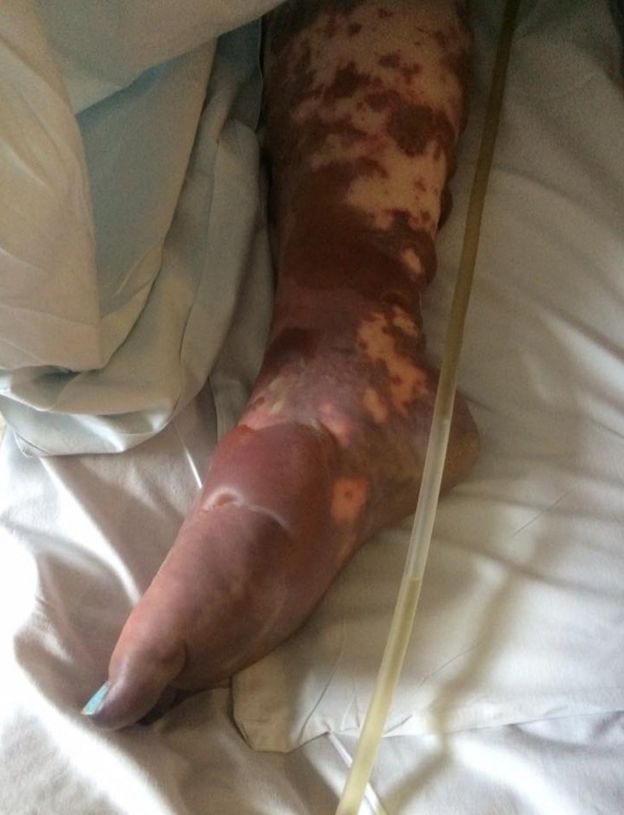 Pés de Charlene Colechin, afetados pela infecção