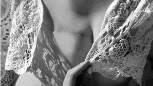 Fotografía en blanco y negro de un pecho con la huella de una mastectomía.
