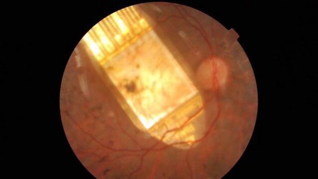 retinal implant