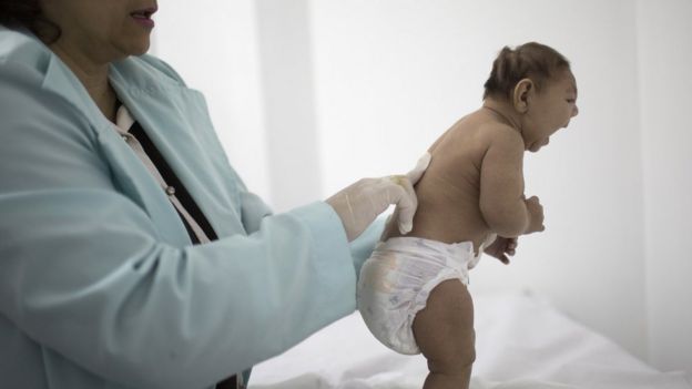 Bebê brasileiro com microcefalia