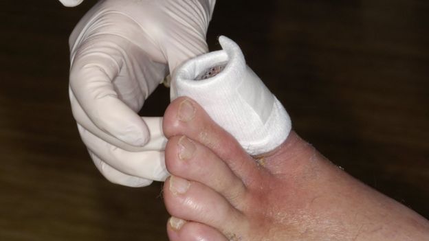 gangrene toe