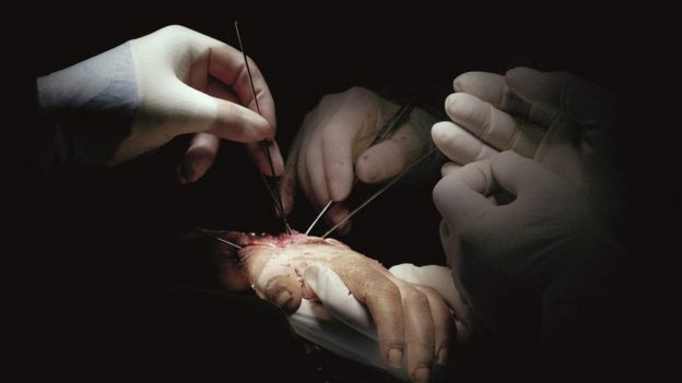 Cirurgia de Simone Butler