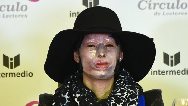 Natalia Ponce de León utilizó durante un tiempo una máscara para proteger su piel.