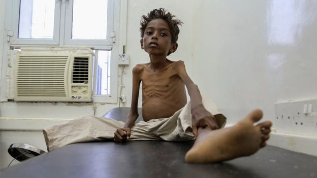 Un niño en un hospital de Yemen