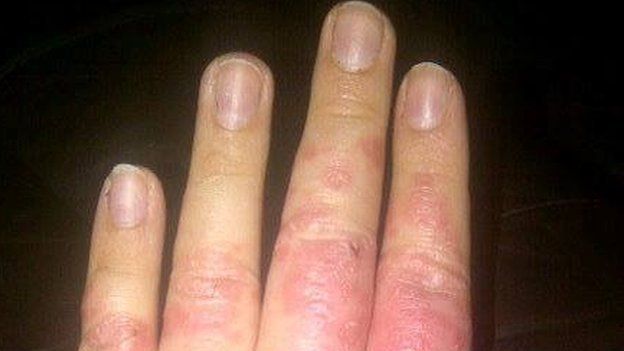 Psoriasis Sufferer Jessica Gough Let Down By Her Gp Bbc Newsbeat