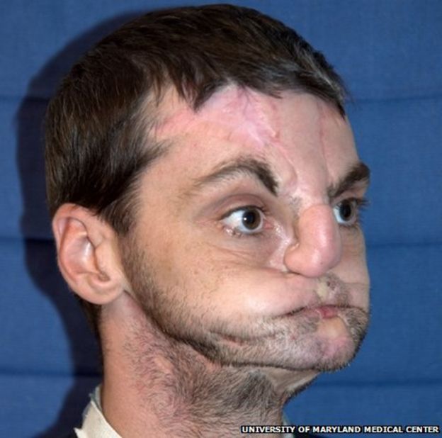 Richard Norris before his face transplant operation (Photo: University of Maryland Medical Center)