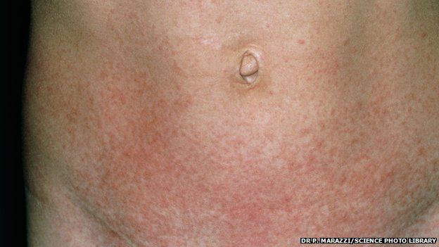 scarlet-fever-cases-rise-to-weekly-high-in-england-bbc-news