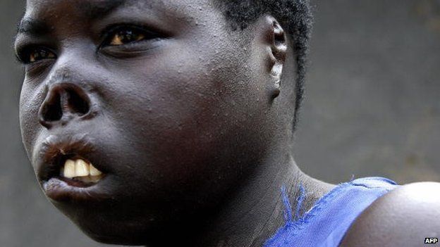 Auma Consolata, a former abductee of the Lord's Resistance Army, bears the scars of her encounter with the rebels who cut off her lips, nose and ears before she was able to escape back to her family (2 September 2006)