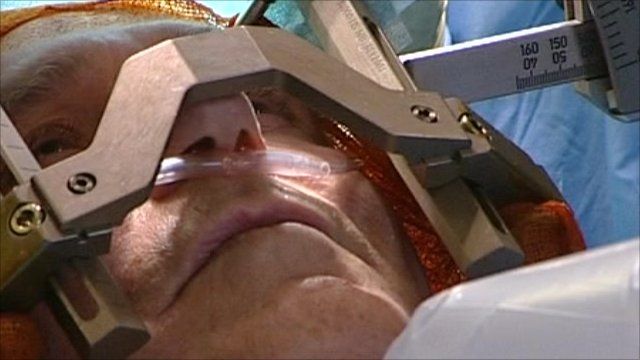 Deep brain stimulation treatment