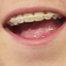 Mystery braces