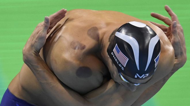 Michael Phelps con circulos rojos en la espalda