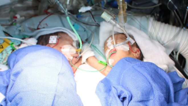 Formerly conjoined twins Lydia and Maya after the operation to separate them (10 December)