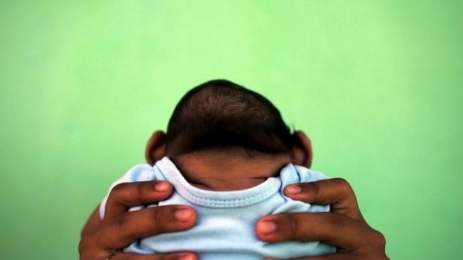 A baby boy with the brain disease microcephaly, Brazil, 11 Feb 2016