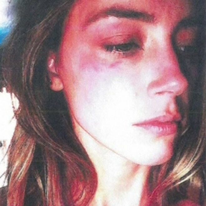 Amber Heard, shown in a photo with a bruised face