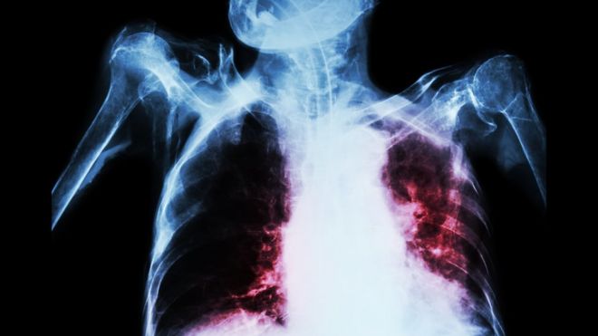 Tuberculosis lungs x-ray - mocked up by Thinkstock