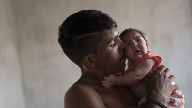 Child with microcephaly