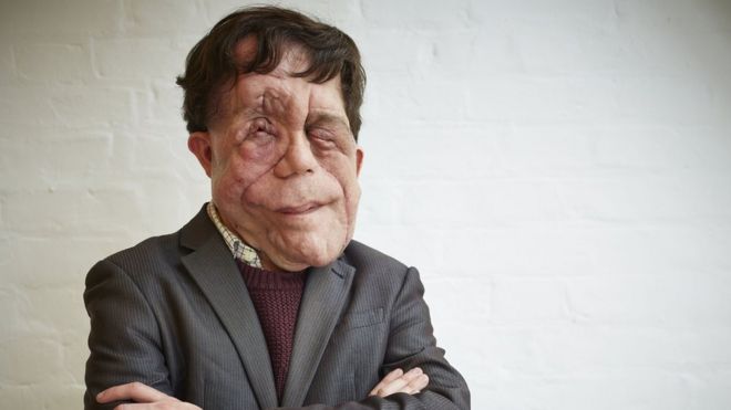 Adam standing with his hands crossed - _84418445_8864667-high_res-the-ugly-face-of-disability-hate-crime