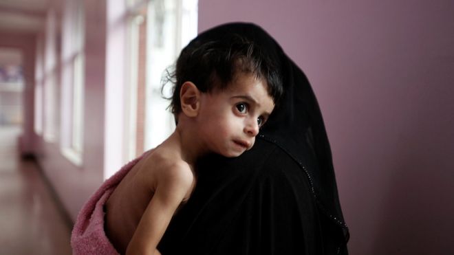 A woman holds her malnourished boy after he was weighed at a hospital malnutrition intensive care unit in Sanaa, Yemen September 27, 2016.