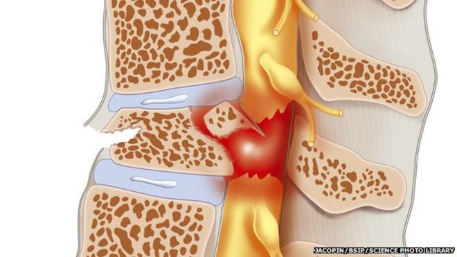 a spinal cord injury