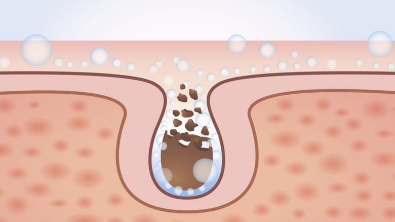 A drawing of a blocked pore