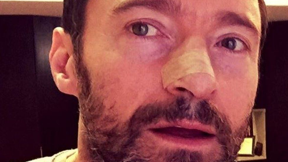 Hugh Jackman Has Skin Cancer Removed On Nose And Posts Sun Safety Warning Bbc Newsbeat 