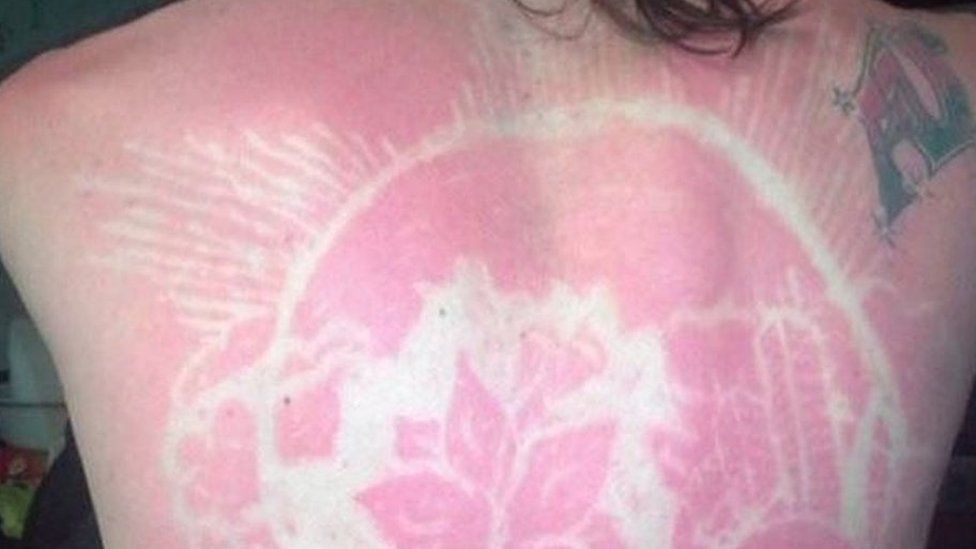 sunburn art is a thing now bbc newsbeat sunburn art is a thing now bbc newsbeat