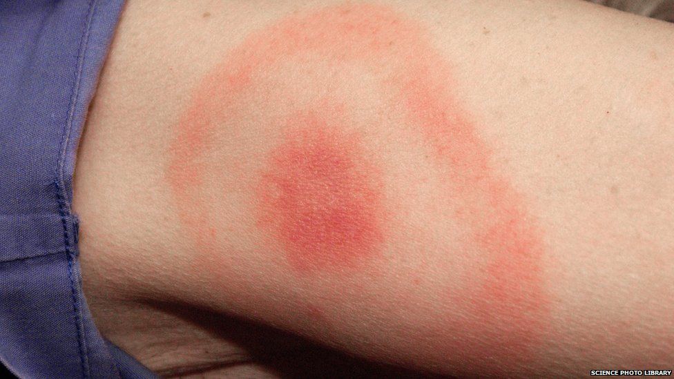 lyme disease tick bite