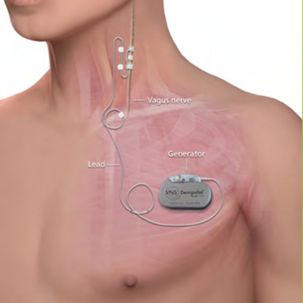 Vagus Nerve Stimulation Implant Praised By Depression Patient Bbc News