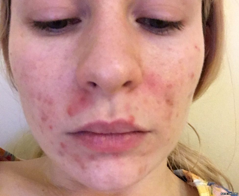 Katie's original acne