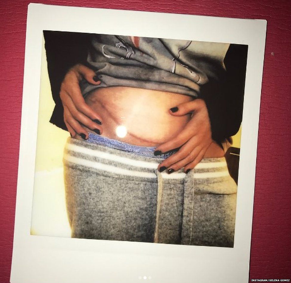 Selena Gomez has also posted photos of her scar from the kidney transplant operation