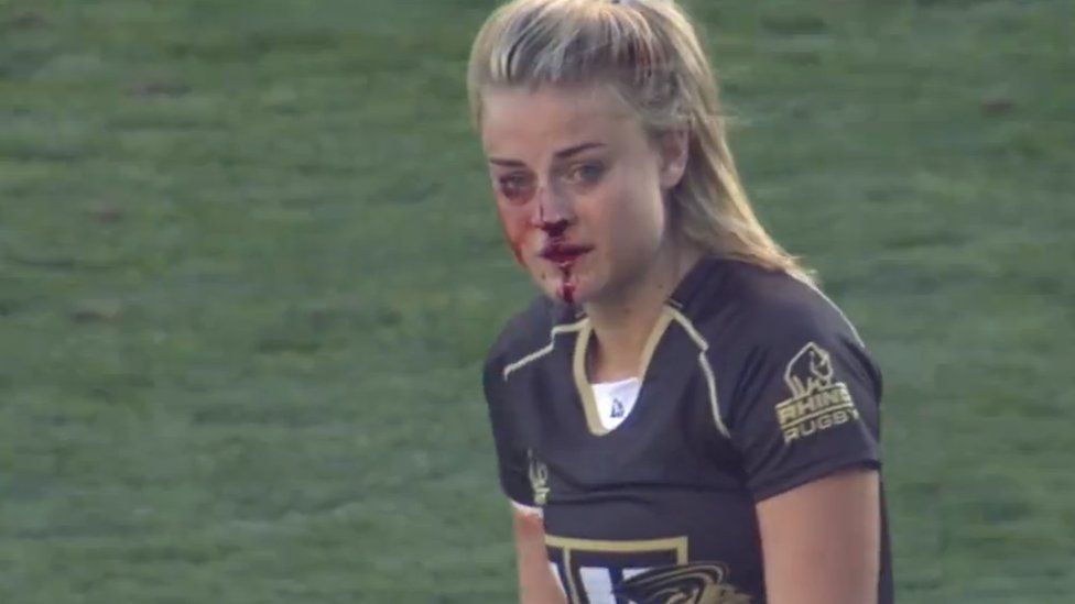 Georgia Page with a bloody nose