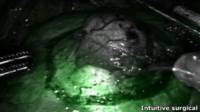 tumor_brillante