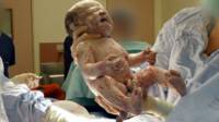 Bebê nasce em cesárea (BBC)