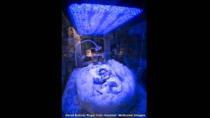 Недоношенный младенец, Дэвид Бишоп, Королевский свободный госпиталь, Лондон