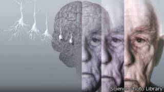dementia brain, spl