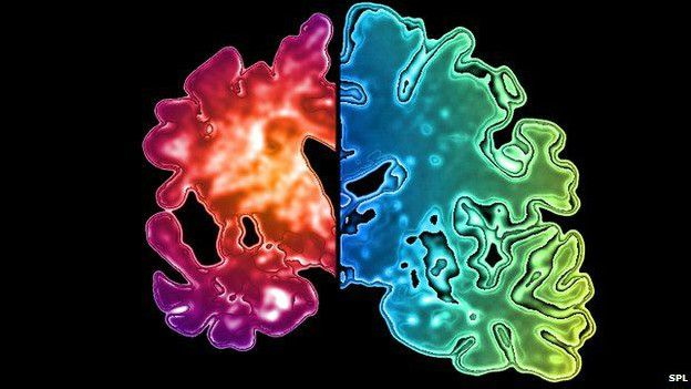 Comparação entre cérebro com demência e cérebro sadio (Foto: SPL)