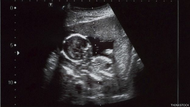 Ultrasonido de un feto